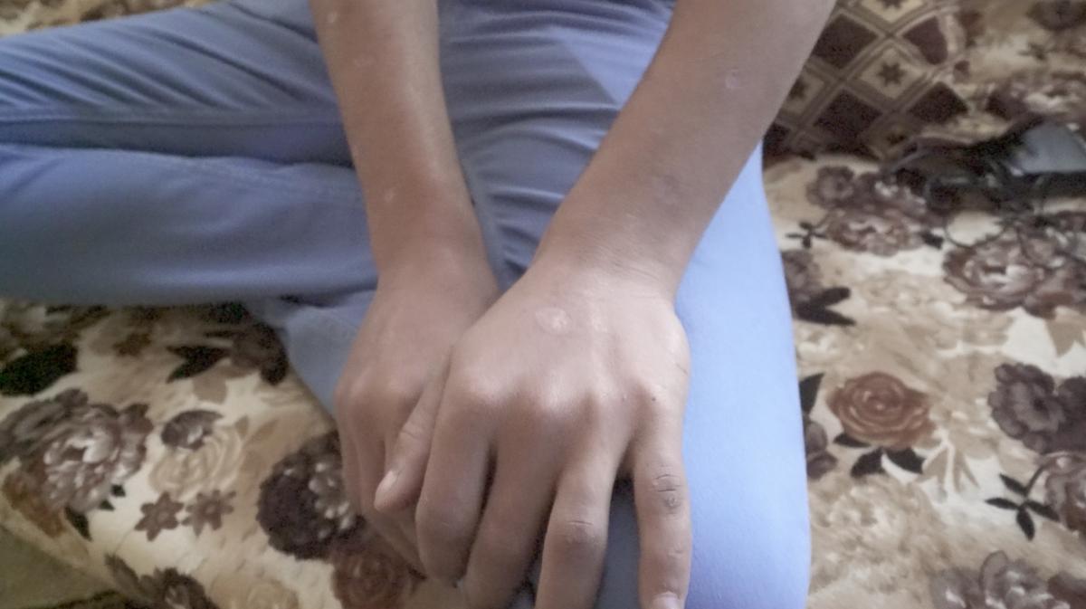 حروق السجائر تغطي يدي وذراعي كريم(18 عاما) الذي احتجزته السلطات الكردية لمدة 13 شهراً. عاد بعد إطلاق سراحه إلى منزله ليتم اعتقاله مجدداً من السلطات التابعة لبغداد التي عذبته واحتجزته لأشهر. @ 2018 سان سرافان